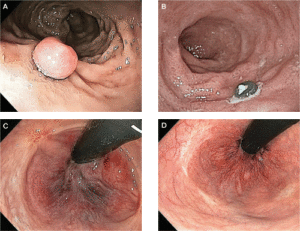 hemorrhoid examples