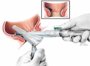 slotted anoscope