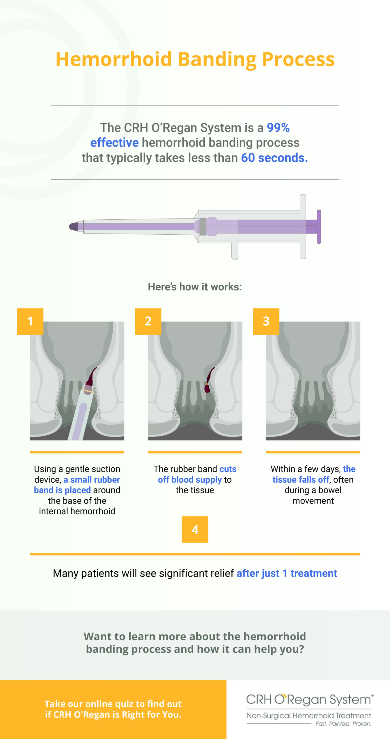 CRH O'Regan System Hemorrhoid Banding Process steps